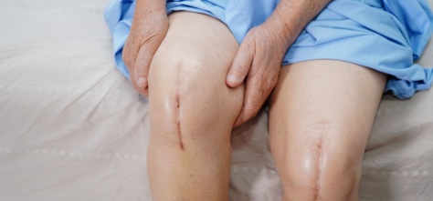 total knee replacement